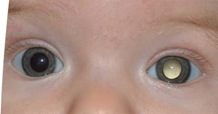 misc-retinoblastoma-0602